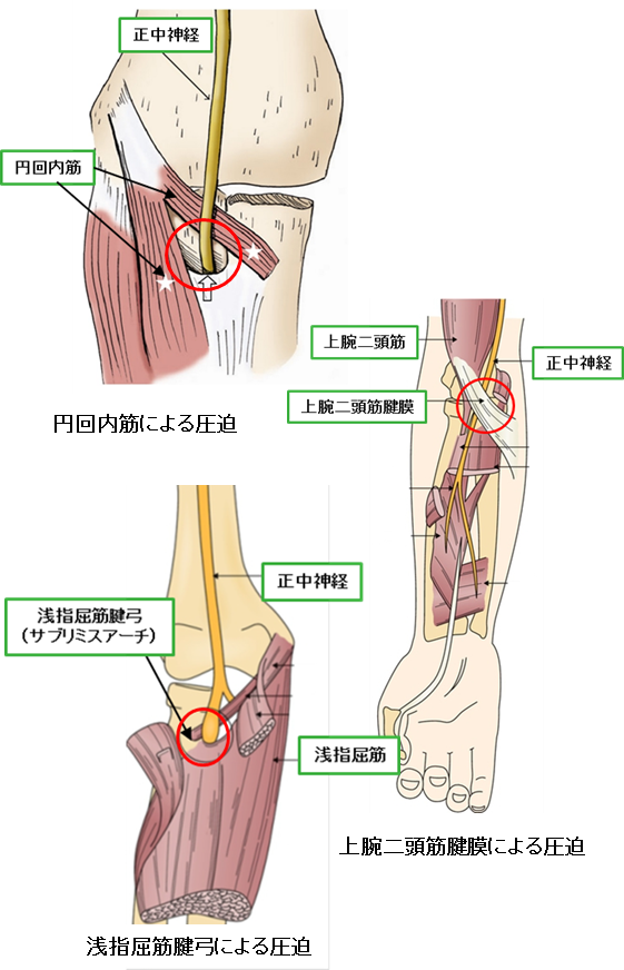 肘関節周辺部～前腕部回内筋症候群（円回内筋トンネル入り口/正中神経）