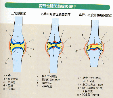 膝の変形ステージ
