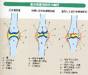 膝の変形ステージ